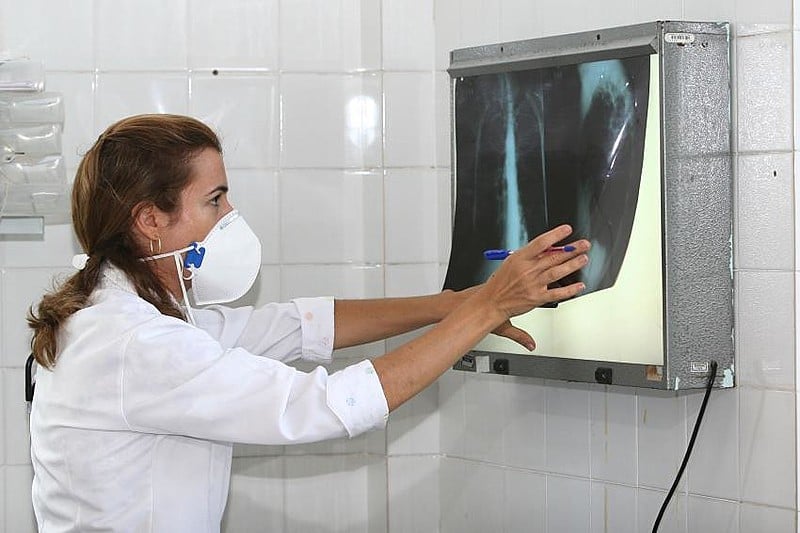 Brics tomarão a dianteira no combate à tuberculose? – Brasil de Fato