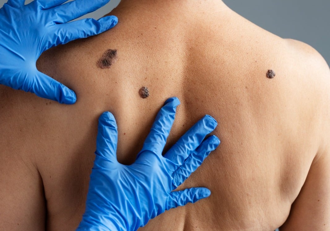 Como identificar e prevenir o melanoma, tipo mais perigoso de câncer de pele – Brasil de Fato