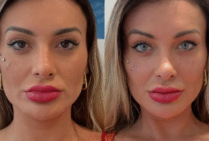 Andressa Urach relata dor após cirurgia para mudar cor dos olhos: ‘Estou arrependida de ter feito’