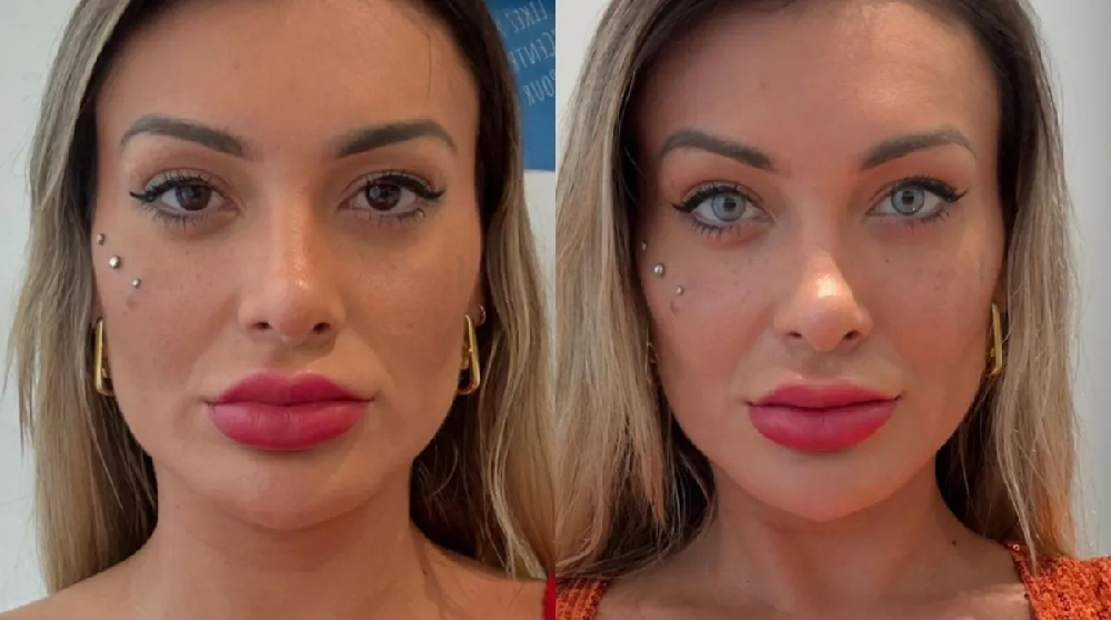 Andressa Urach relata dor após cirurgia para mudar cor dos olhos: ‘Estou arrependida de ter feito’