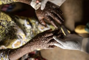OMS mantém alerta global para epidemia de Mpox