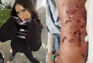 Adolescente leva mais de 500 pontos após ser atacada por dez cães